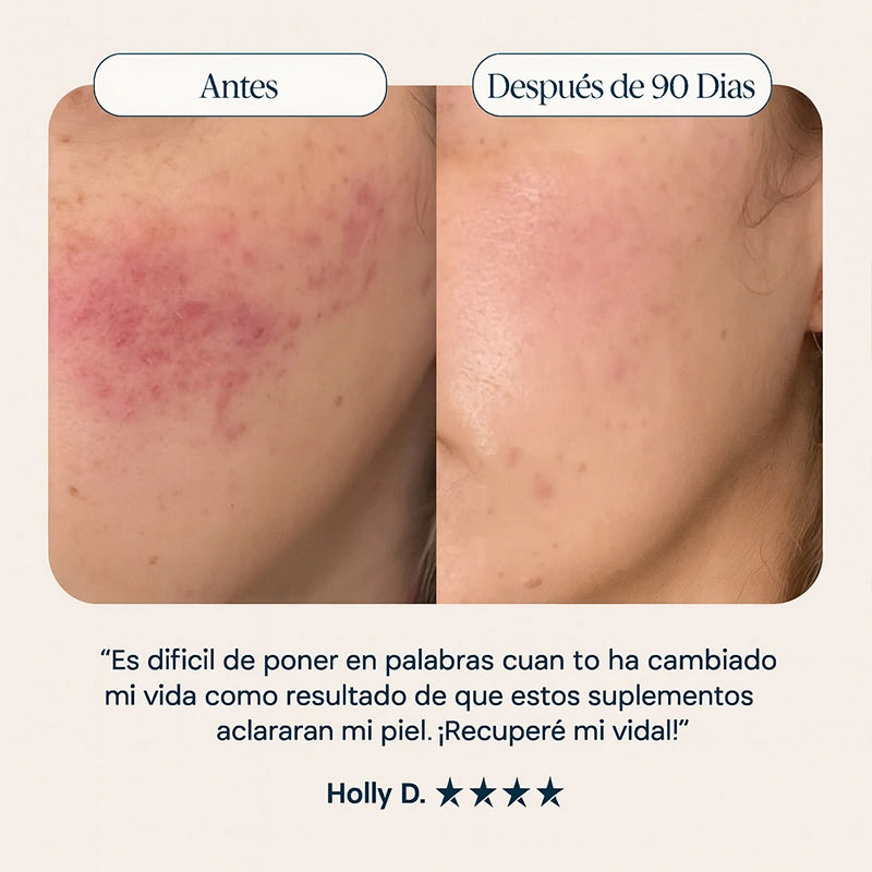 Pore Favor EL Suplemento para el Acné